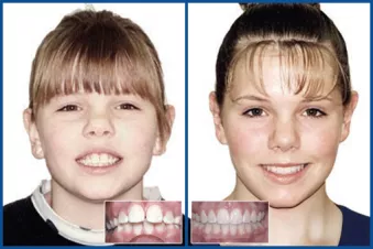 Before and After images of KH using Damon System brackets