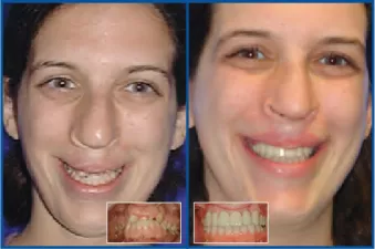 Bilateral Cleft Lip and Palate