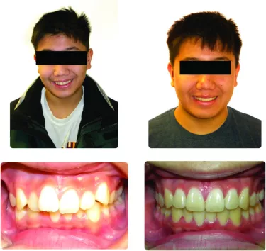 Figure 1: Case comparison. Patient on top: Treated with the leading aligner brand: 5 visits; 3 refinements. 73 aligners; 20 months.