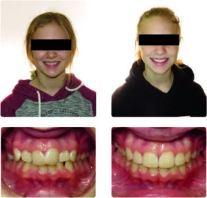 Patient on bottom: Treated with Spark Clear Aligner System: 3 visits; 1 refinement; 40 aligners; 9 months.