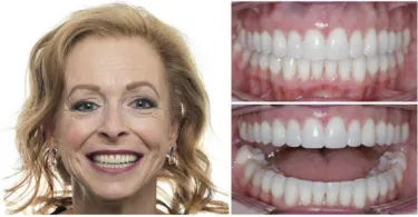 Lady with After Braces treatment pictures