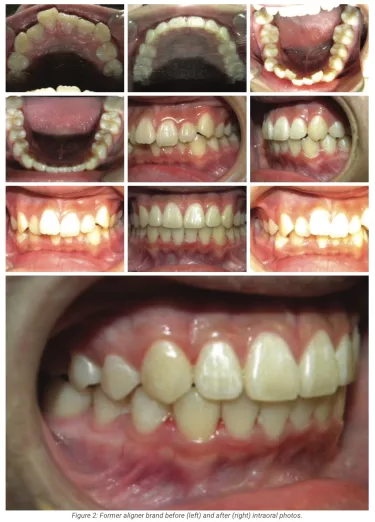 Figure 2: Former aligner brand before (left) and after (right) intraoral photos.