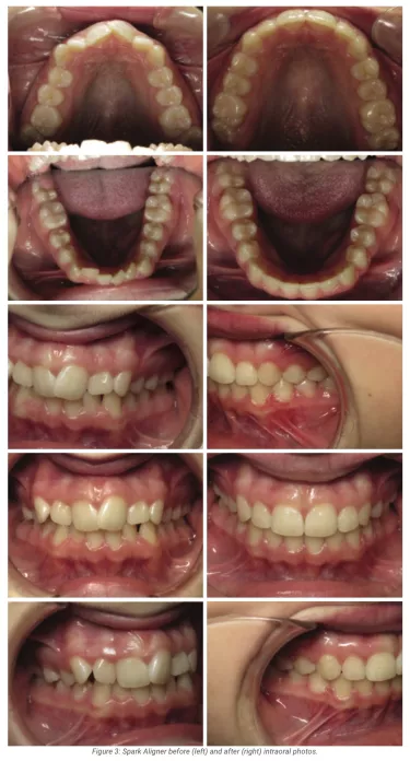 Figure 3: Spark Aligner before (left) and after (right) intraoral photos