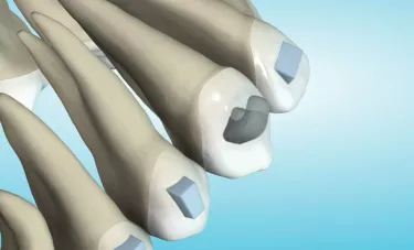 Software Image of teeth and roots with device placement