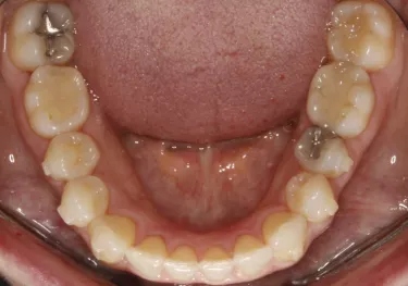 TruGEN XR after Patient with stubborn lower incisors