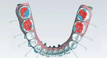 Patient showing molar buildups.