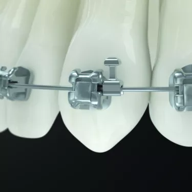 Ormco Ultima Hooks simplify Orthodontic Mechanics Ormco