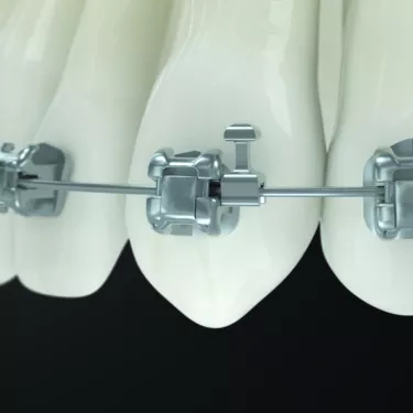 Ormco Ultima™ Hooks simplify Orthodontic Mechanics