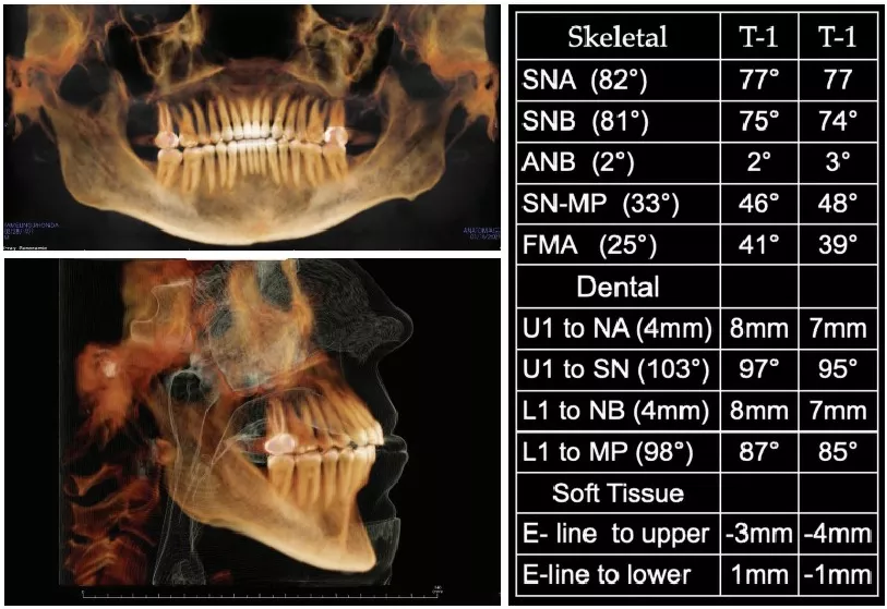 Bicknell Case 1 Post Treatment Radiograph