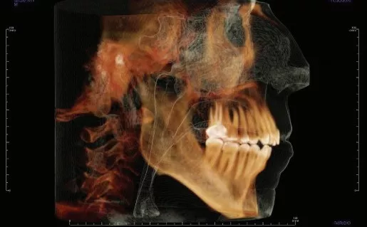 Bicknell Pretreatment Radiograph cropped