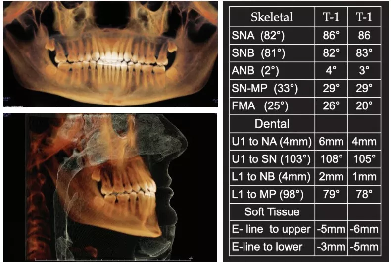 Bicknell Post Treatment Radiograph