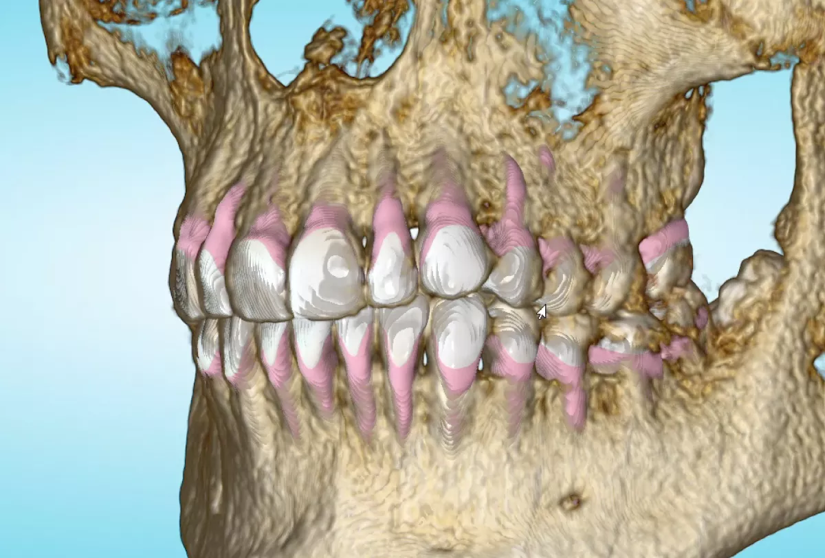 CBCT Root Visualization with the Spark TruRoot Feature