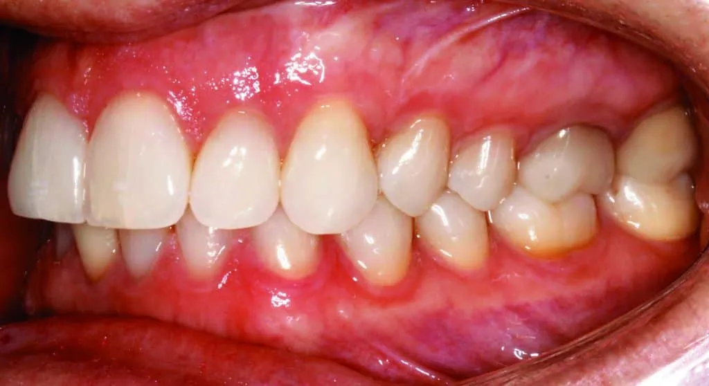 Pre Spark Treatment photo of the left side of a woman's mouth