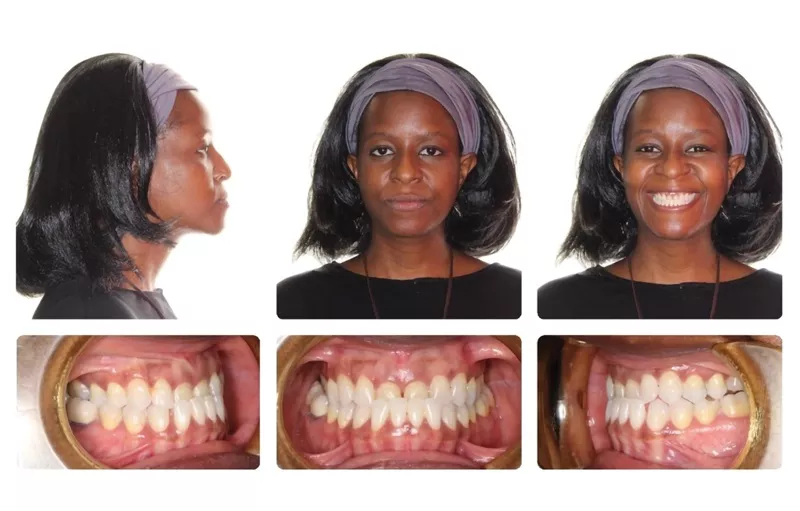 Bogdan Pre Treatment panel for a class III malocclusion