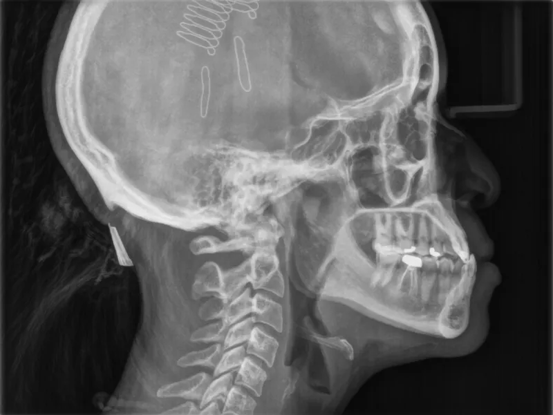 Bogdan Class III Malocclusion pre treatment radiograph