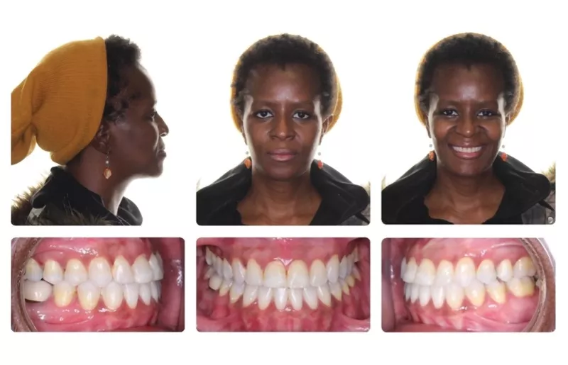 Bogdan Class III Malocclusion Post treatment panel