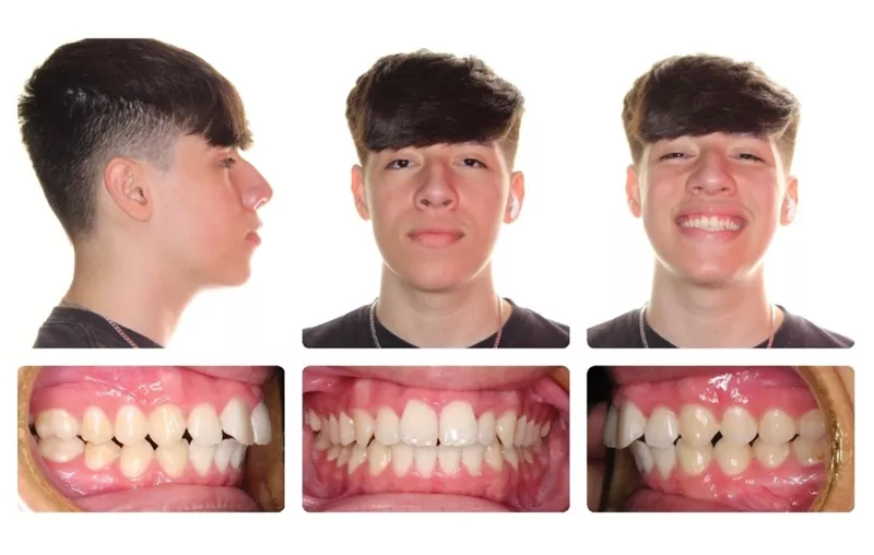 Bogdon Pre treatment full panel