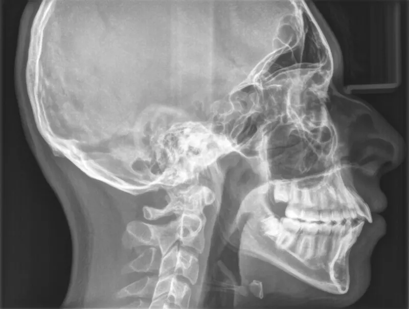 Bogdan Pre Treatment radiograph