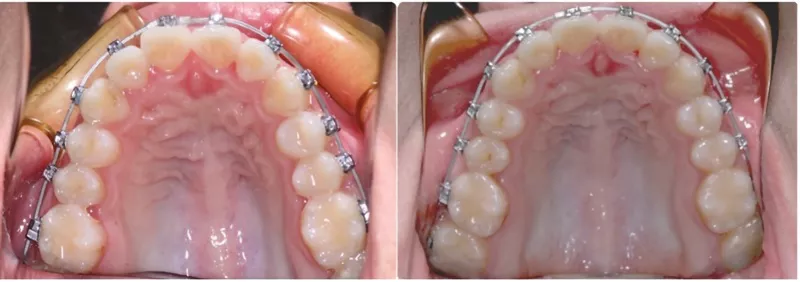 Before and mid treatment images