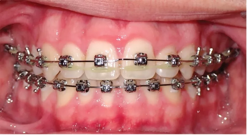 Bogdan Treatment photo showing the only wire bend needed