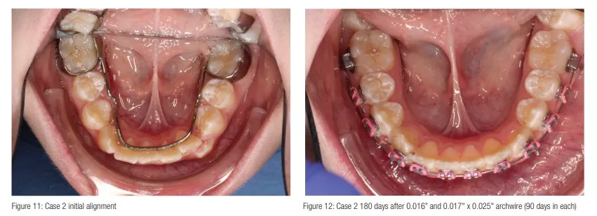Sarver case 2 before and after examples