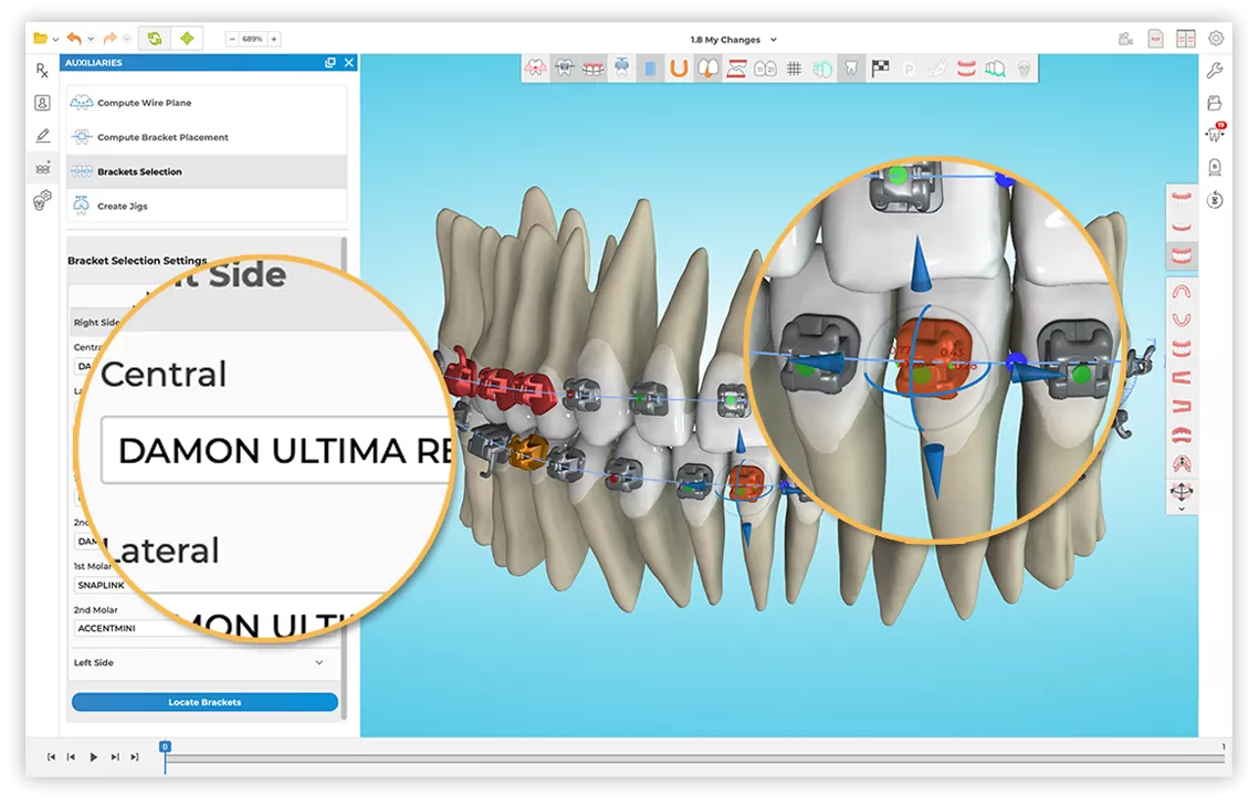 Orthodontic software interface showing digital bracket placement and tooth positioning adjustments for treatment planning