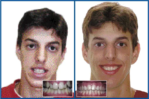Class I Nonextraction – Youth (open bite with posterior crossbite – very narrow deep palate)