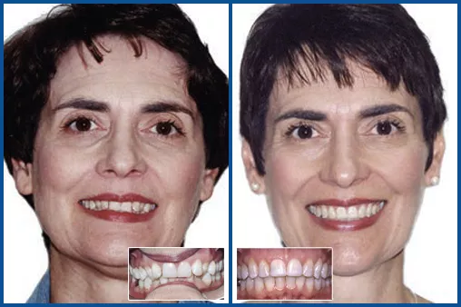 Damon System Before and after for HH2