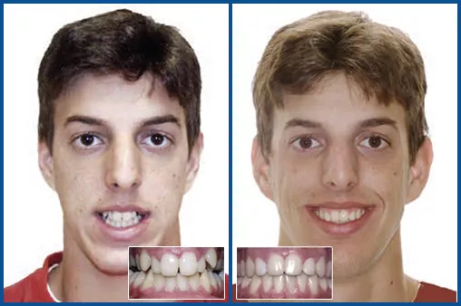 Damon Case Before and After for HH