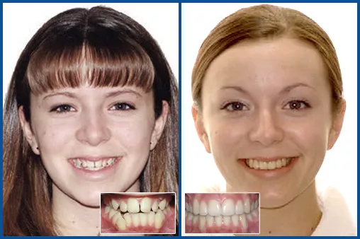 Damon Ultima treatment Panel for HS