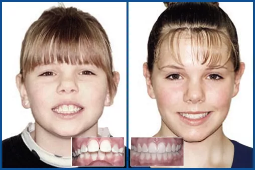 Before and After images of KH using Damon System brackets