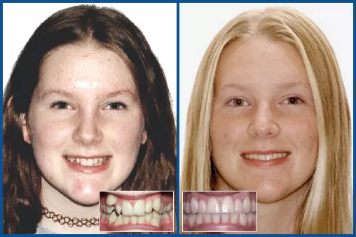 Damon Ultima treatment Panel for teen SH