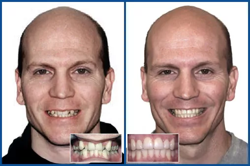 Damon Ultima treatment Panel for TS