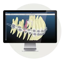 Digital orthodontic setup displayed on a screen showing the Insignia custom treatment system and bracket positioning