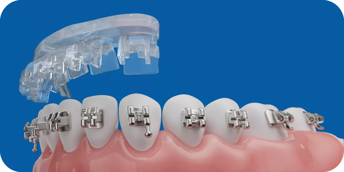 Transparent orthodontic bonding jig positioned above brackets on teeth for precise digital bonding placement
