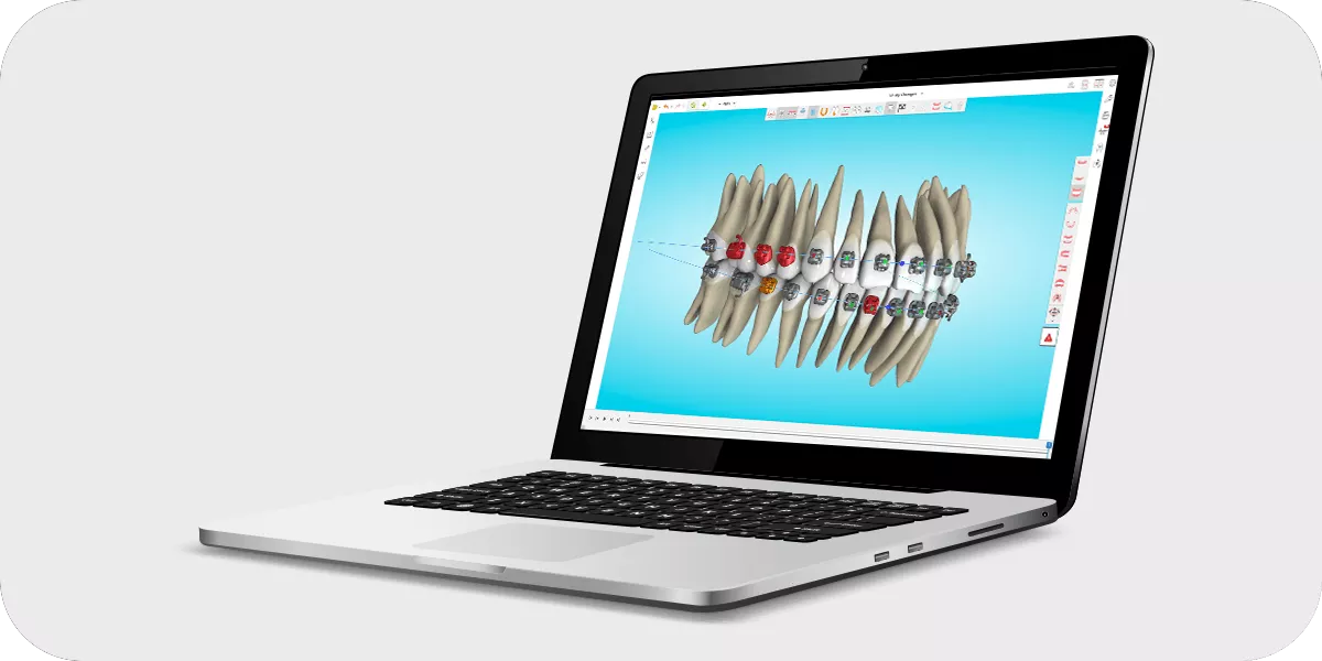 Laptop displaying orthodontic digital bonding workflow with 3D teeth model and bracket positioning in planning software