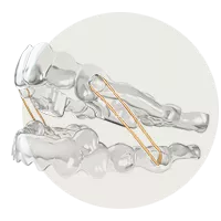 Clear aligner model illustrating the Spark BiteSync feature